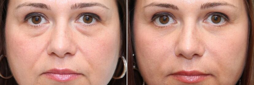 Prieš ir po blefaroplastikos – riebalinio kūno po akimis pašalinimas ir odos stangrinimas