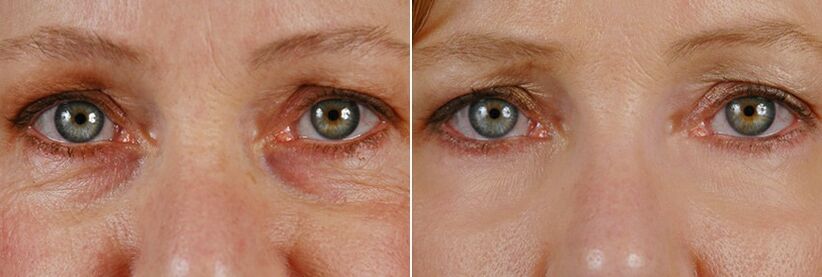 Prieš ir po lazerinės operacijos – odos aplink akis atjauninimas